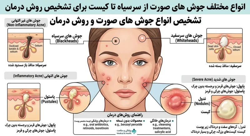 انواع مختلف جوش های صورت از سرسیاه تا کیست برای تشخیص روش درمان